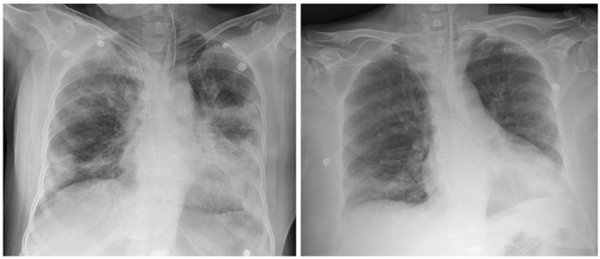 71세 남성이 혈장치료를 받기 전(좌)과 후(우)의 흉부 X-ray 사진으로 혈장치료 후 폐렴 등으로 뿌옇게 보이던 폐가 나아지고 있다. 사진=국제학술지 'JKMS'